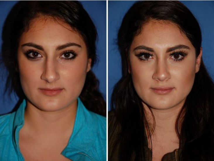 open rhinoplasty before and after